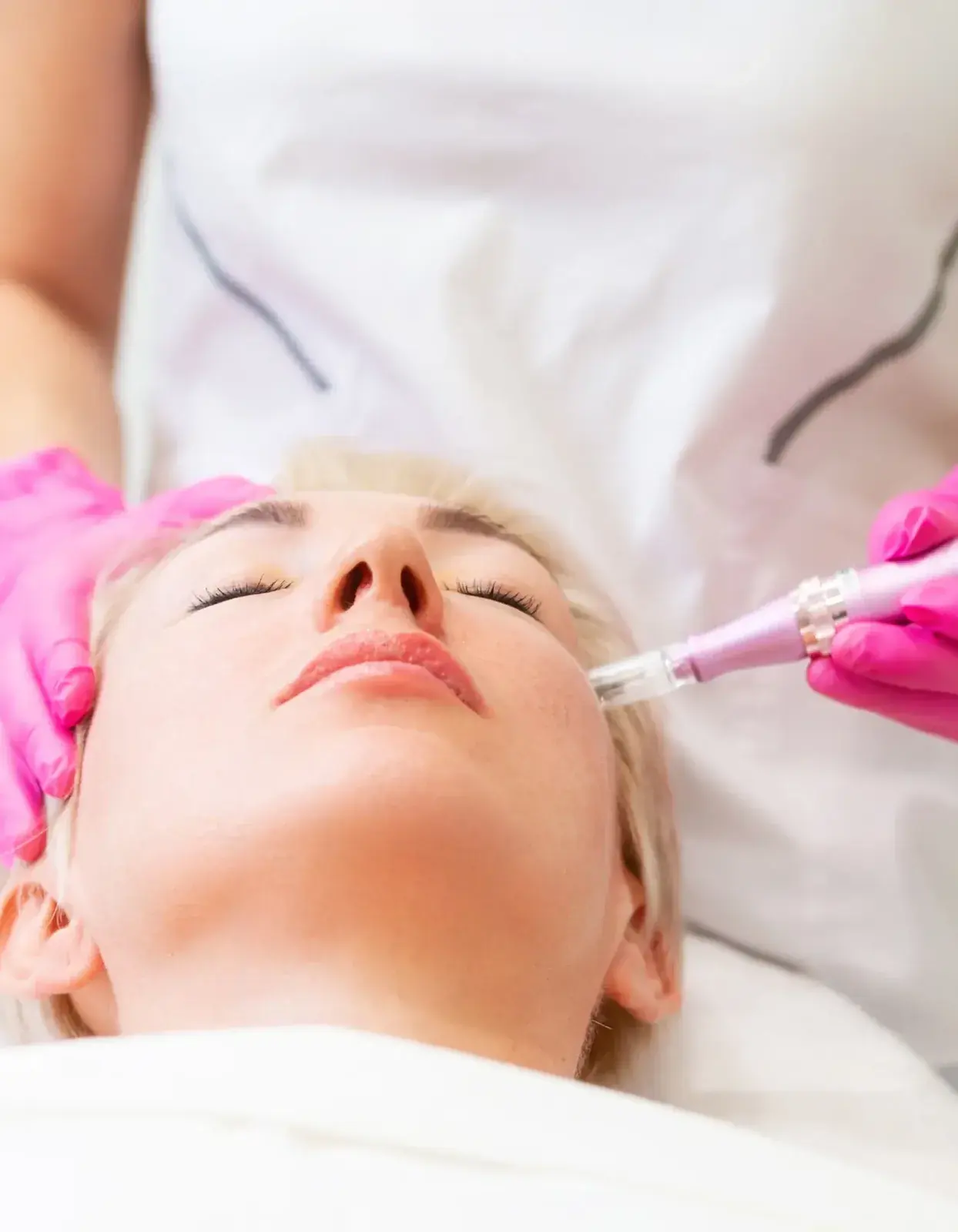 DP4 Microneedling