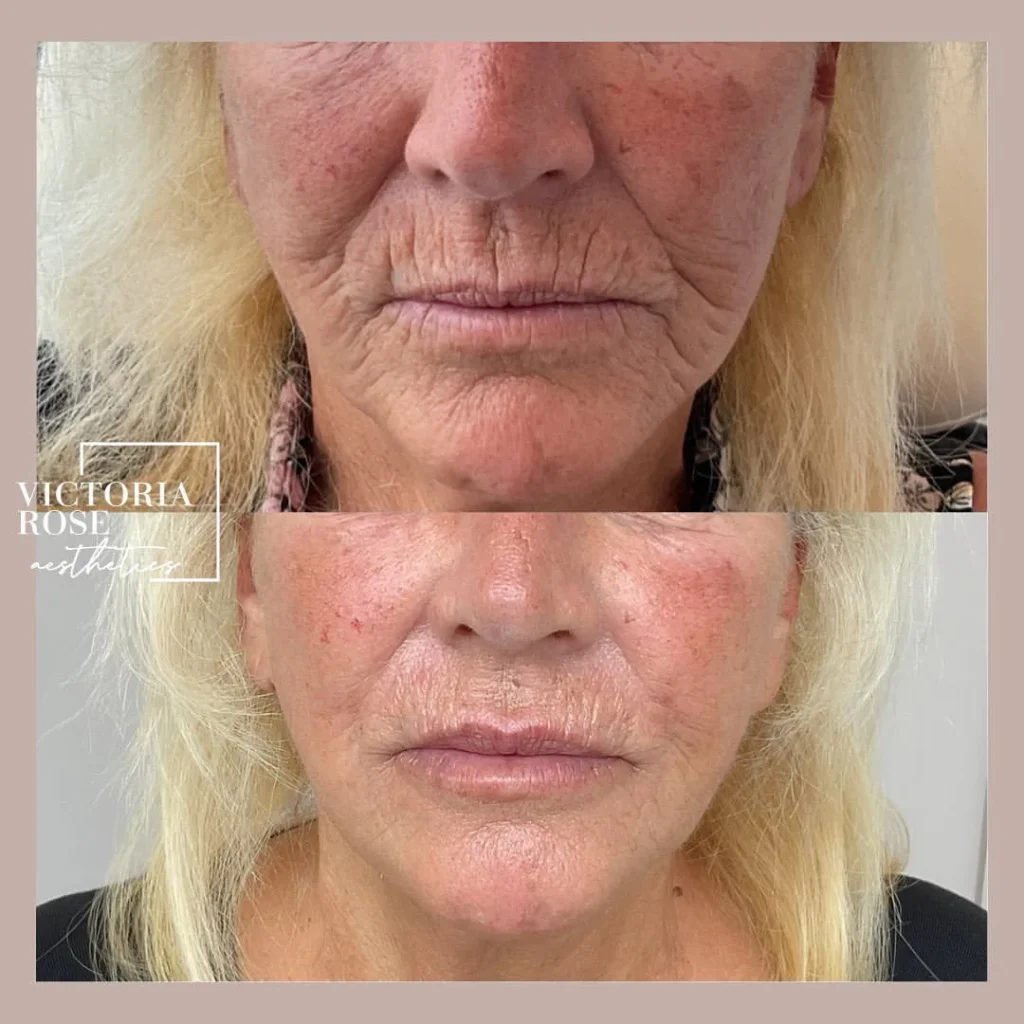 facial rejuvenation before and after 1