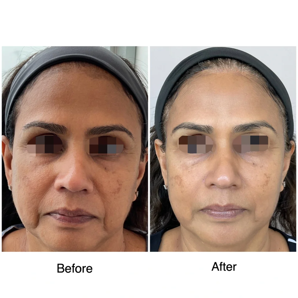 rf microneedling before and after