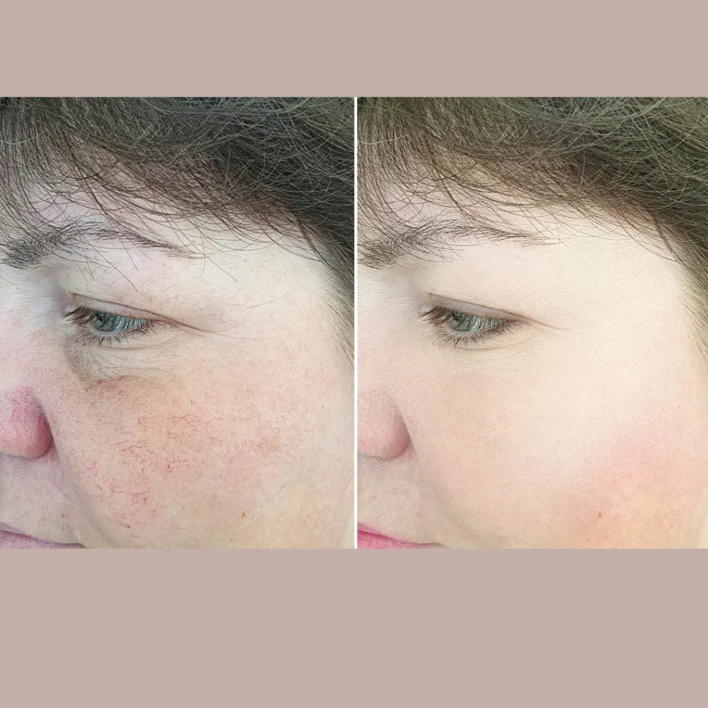 Laser Rosacea Treatment Before and After